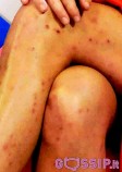 le_gambe_di_flavia_vento_tartassate_dalle_bolle_0efd